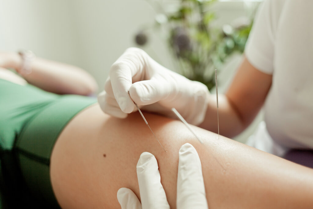 Rehclinic Daria Święszek fizjoterapia Suche Igłowanie