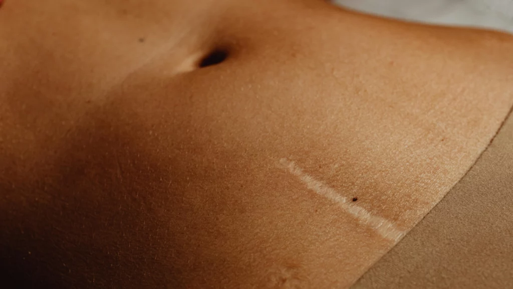 praca na bliznac rehclinic